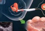 失独的家庭想要孩子可以通过试管婴儿技术吗？